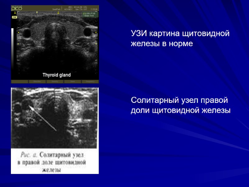 УЗИ картина щитовидной железы в норме Солитарный узел правой доли щитовидной железы